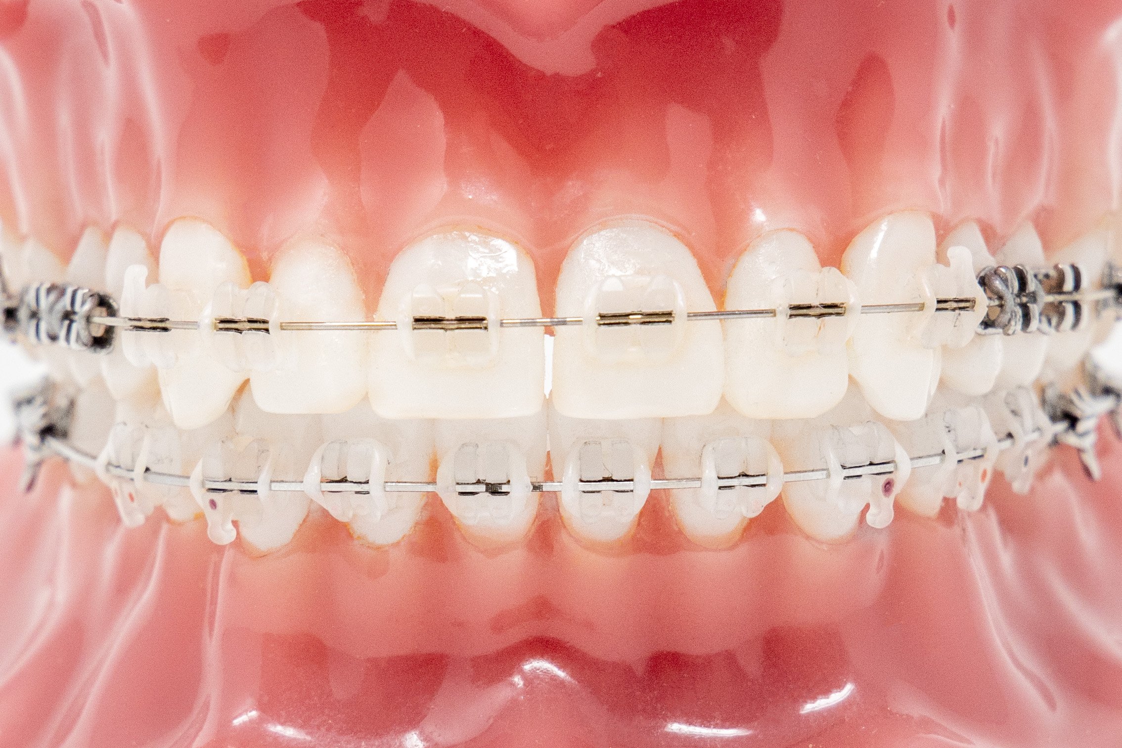 Types Of Braces, Traditional, Invisalign, Damon